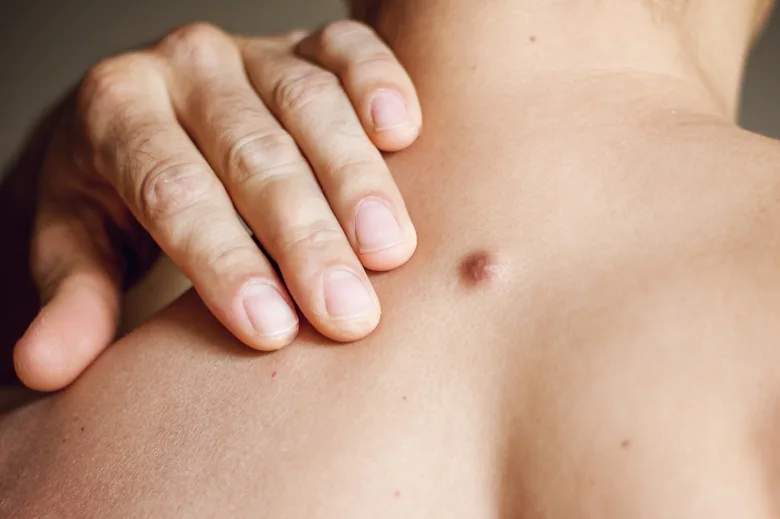 Hand on skin mole