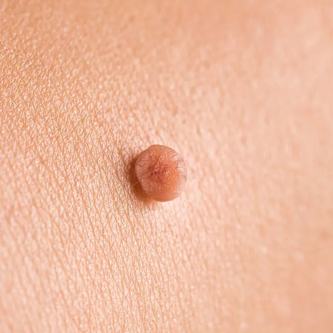 Malý hnědý uzlík na kůži připomínající dermatofibrom.