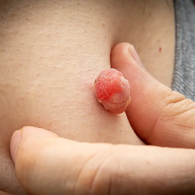 Růžový dermatofibrom na lidské kůži držený prstem.