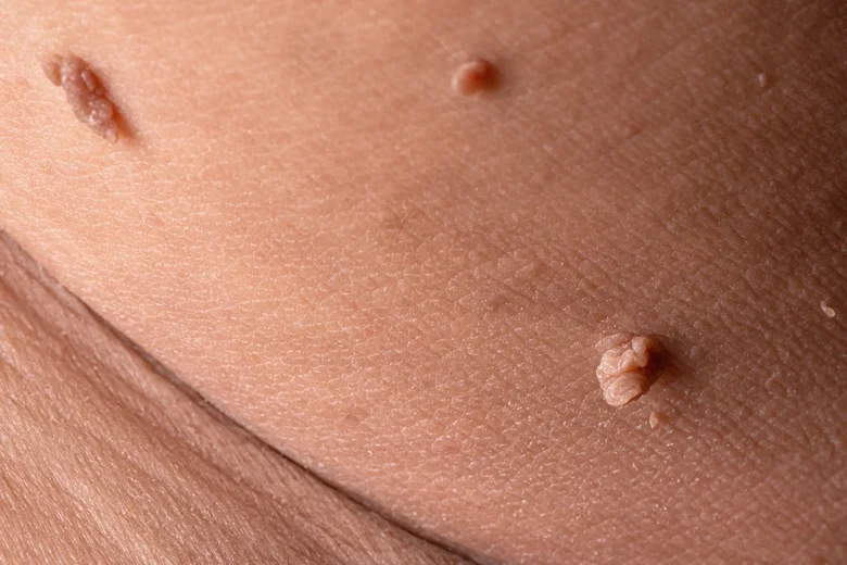 Tři dermatofibrómy na lidské kůži - typické uzlíky.