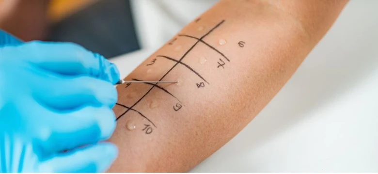 Kožní kožní test pro diagnostiku alergií s kapkami na kůži.