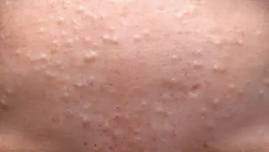 Blízký záběr na kůži s mnoha komedony a bílými hlavičkami.